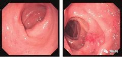 萎縮性胃炎不可怕，只要