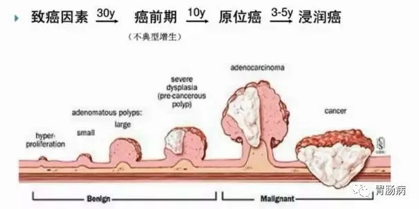 體檢查出腸息肉一定要切除！ 95%腸癌由它演變而來